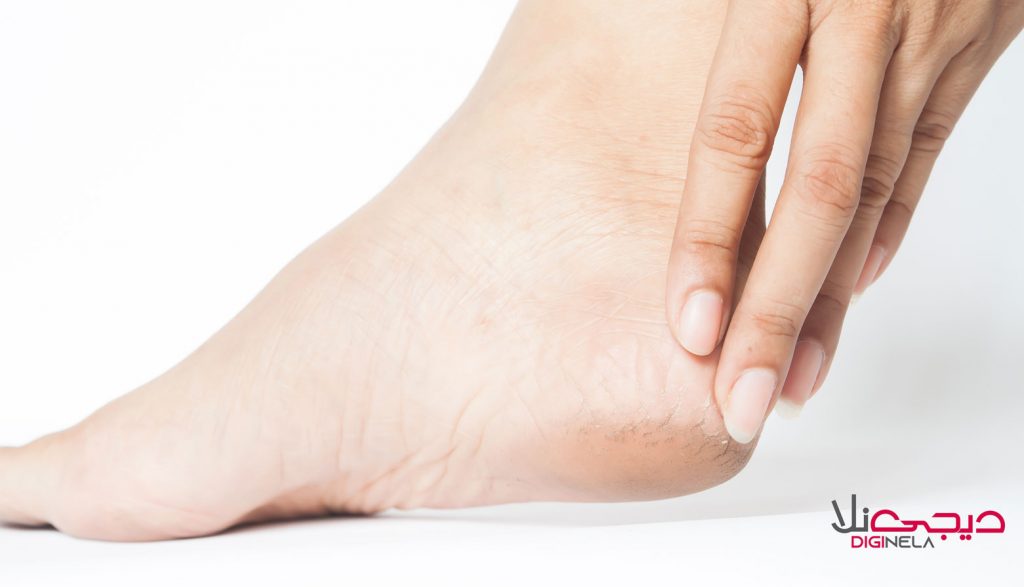 ترک پا و دلایل ایجاد آن، درمان خانگی پینه پا، درمان با طب سنتی پینه پاشنه پا